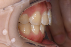 インビザラインはすきっ歯・出っ歯などの治療が可能