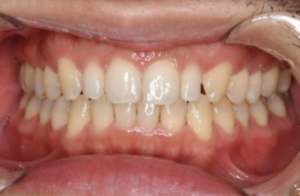 顎間ゴムは歯や顎の位置を誘導する