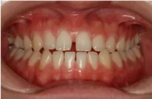 前歯の歯並びのみ気になっている等の場合は部分矯正