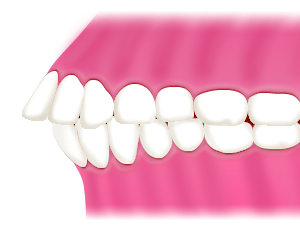 悪い歯並びの要素は7種類