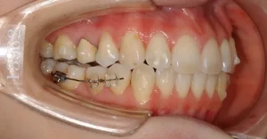 部分矯正は一部分の歯のみ矯正したい方におすすめ