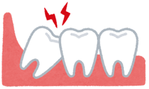 歯の治療中を放置すると不正咬合のリスク
